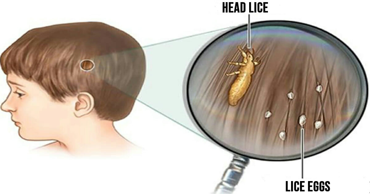 Head lice